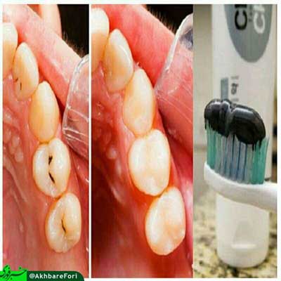 خمیر دندانی که دندانپزشکان را بیکار می‌کند!
