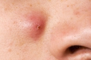 کیست پوستی صورت چیست و چگونه درمان می شود؟ کیست پوستی صورت چیست و چگونه درمان می شود؟