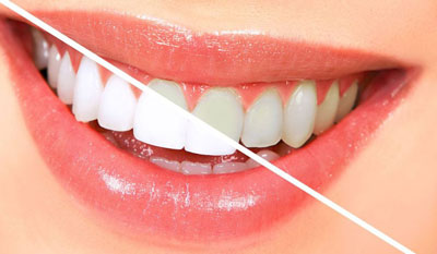 این 6 عادت باعث زرد شدن دندان ها می شوند