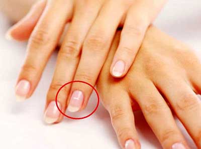 علت لکه های سفید روی ناخن ها چیست؟